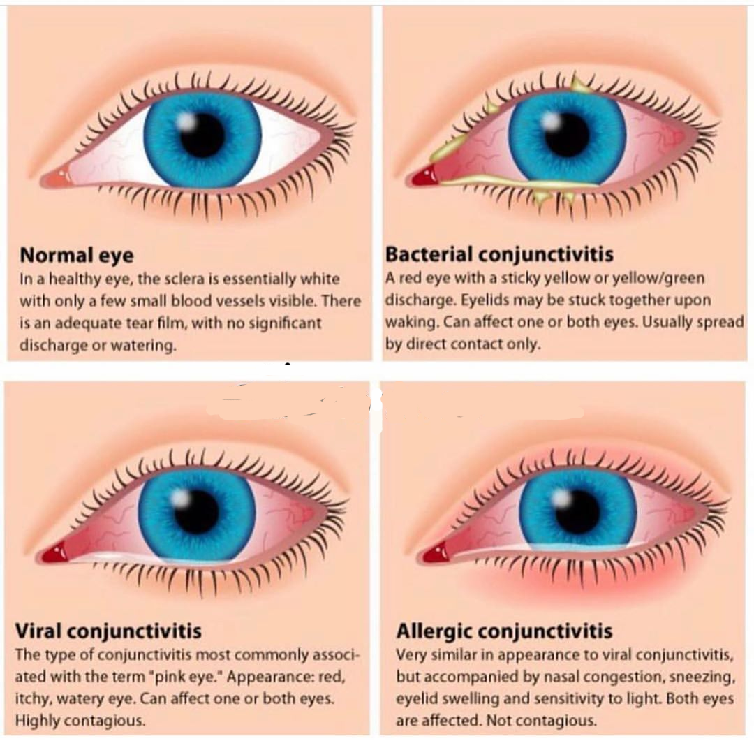 Tipos de conjuntivitis